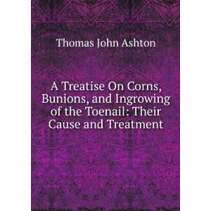  A Treatise On Corns, Bunions, and Ingrowing of the Toenail 
