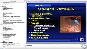   Eye Ocular Trauma Conjunctivitis PowerPoint Presentation on CD  