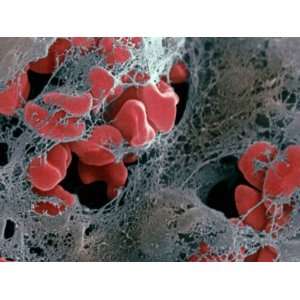  Blood Clot Formation, Showing Trapped Red Blood Cells or 