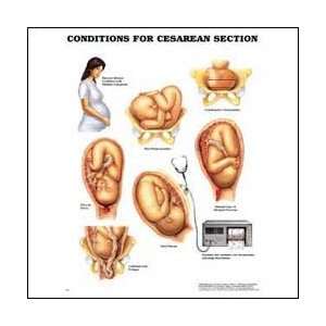 Conditions For Cesarean Section Anatomical Chart 20 X 26 