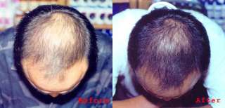   HAIR REGROWTH *MEN & WOMEN HAIR LOSS* THINNING THICKER TREATMENT PILLS